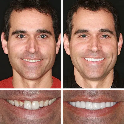 🌎Ends Today: 70% OFF! ⏰LUMIVO® Medical Full Denture with Strong Suctiond🦷Obtain American Dental Association (ADA) Certification