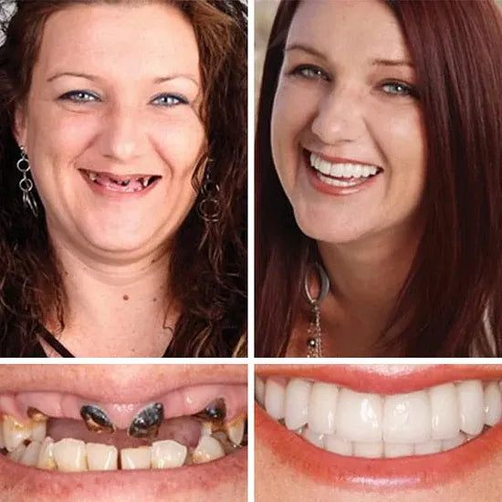 🌎Ends Today: 70% OFF! ⏰LUMIVO® Medical Full Denture with Strong Suctiond🦷Obtain American Dental Association (ADA) Certification