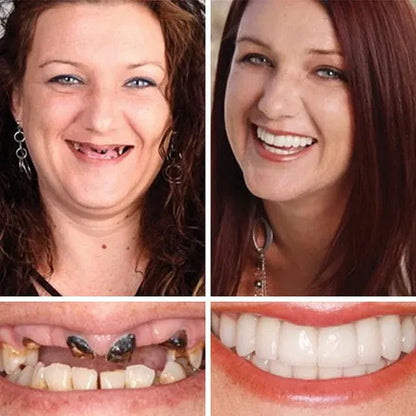 🌎Ends Today: 70% OFF! ⏰LUMIVO® Medical Full Denture with Strong Suctiond🦷Obtain American Dental Association (ADA) Certification